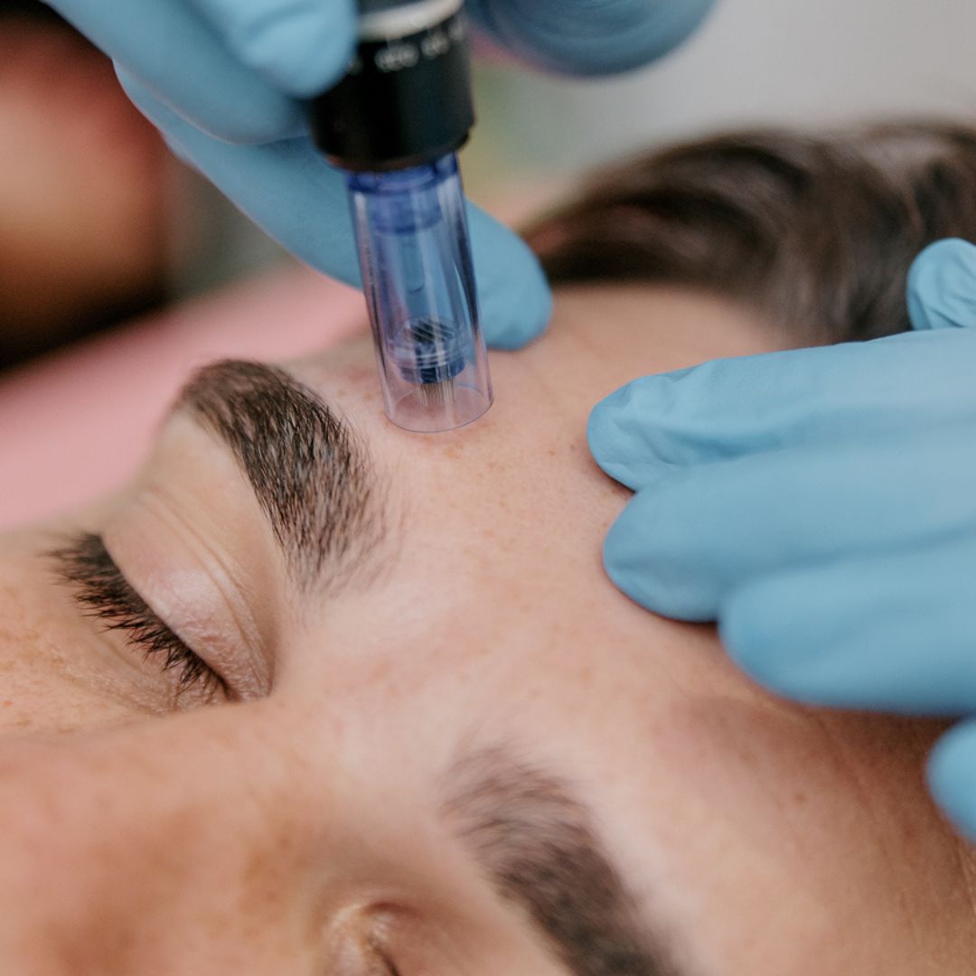 Eyebrow Tattoo Removal